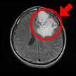 脳腫瘍例